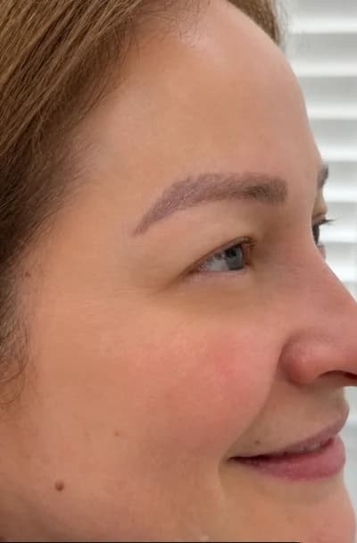 After Botox, follow-up