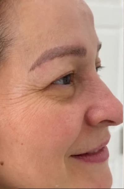 Before Botox