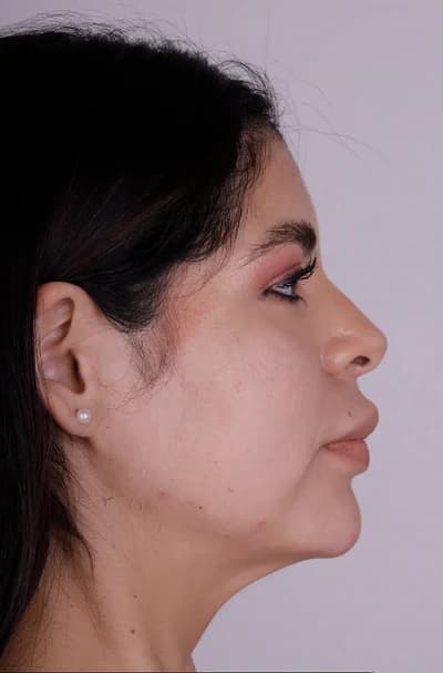 After Fillers, follow-up