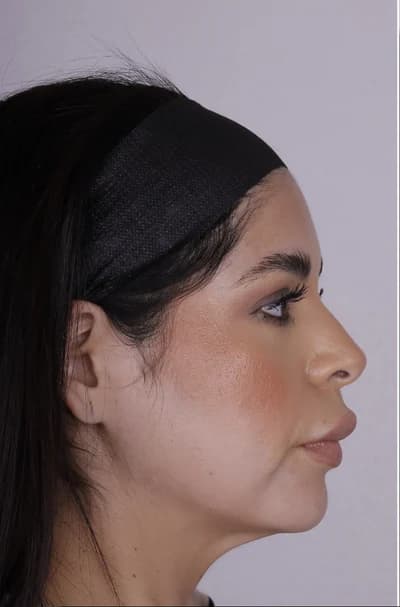 Before Fillers