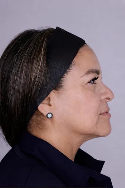 After Sculptra, follow-up