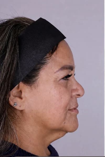 Before Sculptra